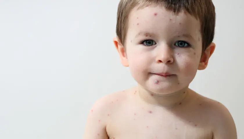 Bambino con macchie rosse sul viso e sul corpo, tipiche delle malattie esantematiche infantili.
