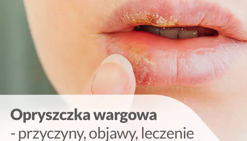 Opryszczka wargowa, jedna z chorób na ustach, objawia się pęcherzykami i strupkami. Palec zbliża się do ust.