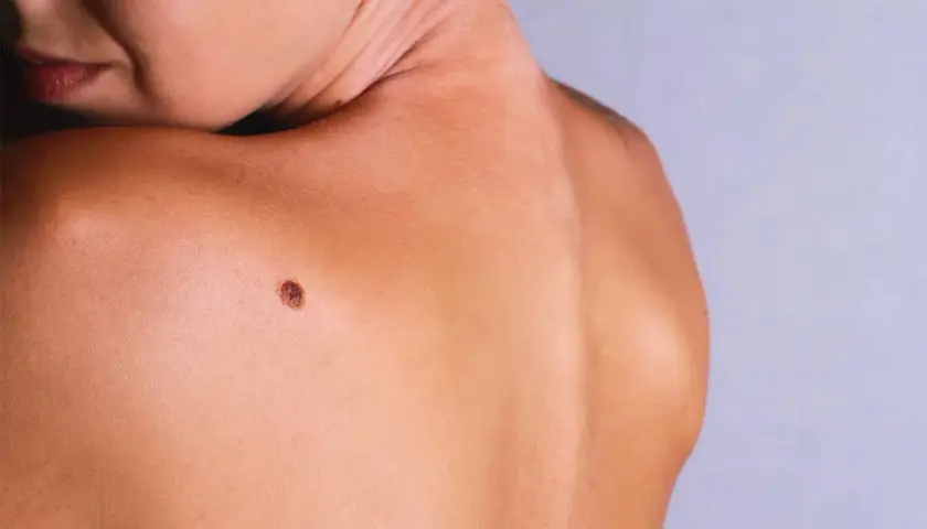 Gros plan sur une épaule et le cou d'une personne, avec un grain de beauté qui dépasse sur la peau bronzée.