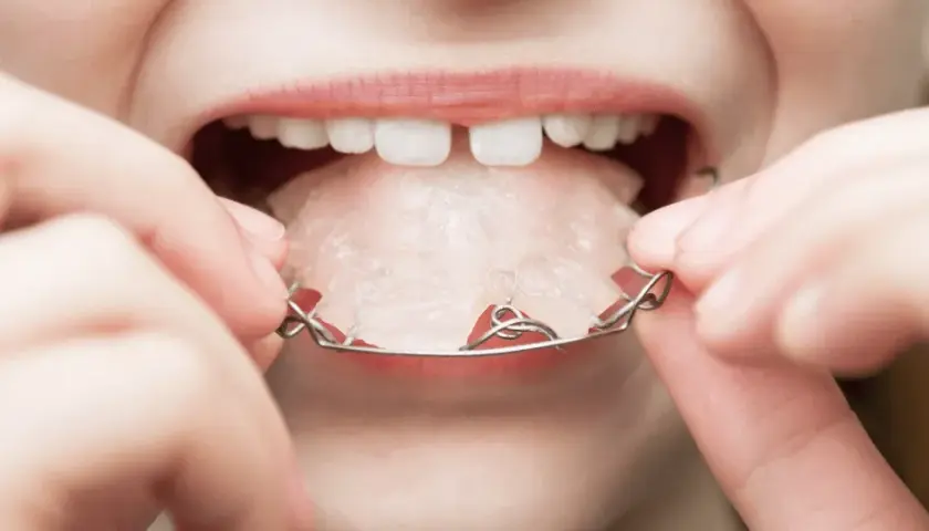 Aparat na zęby dla dziecka: Jak wygląda? Ruchomy, stały, Invisalign