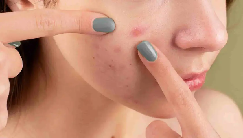 Dita che toccano il viso con acne, un gesto che può peggiorare la dermatillomania come smettere.