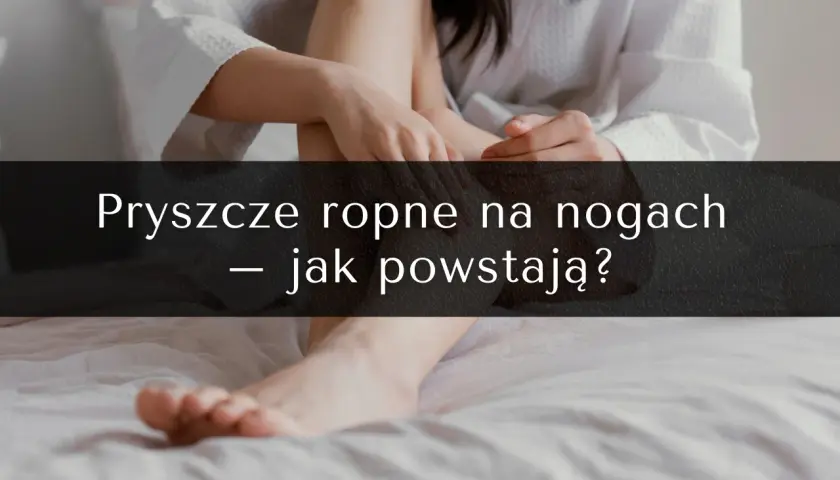 Pryszcze na nogach: przyczyny, skuteczne metody leczenia i profilaktyka