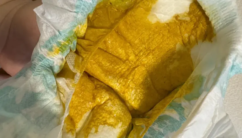Pannolino con feci gialle e liquide, indicative di diarrea neonato. La consistenza è molto morbida e acquosa.