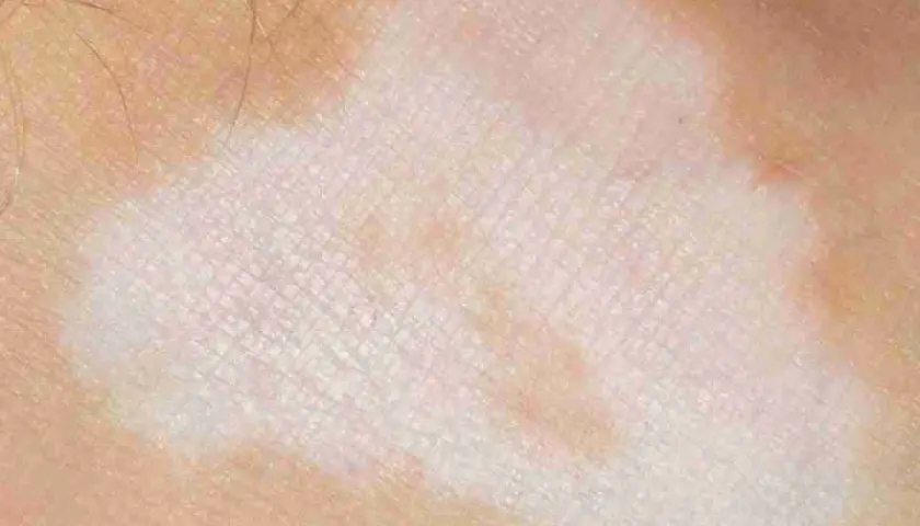 Pelle con macchie bianche e rosa, tipiche del nevo di Sutton nei bambini.
