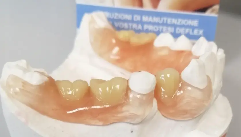 Protesi Deflex su modello dentale. Scopri il protesi deflex prezzo per un sorriso perfetto.