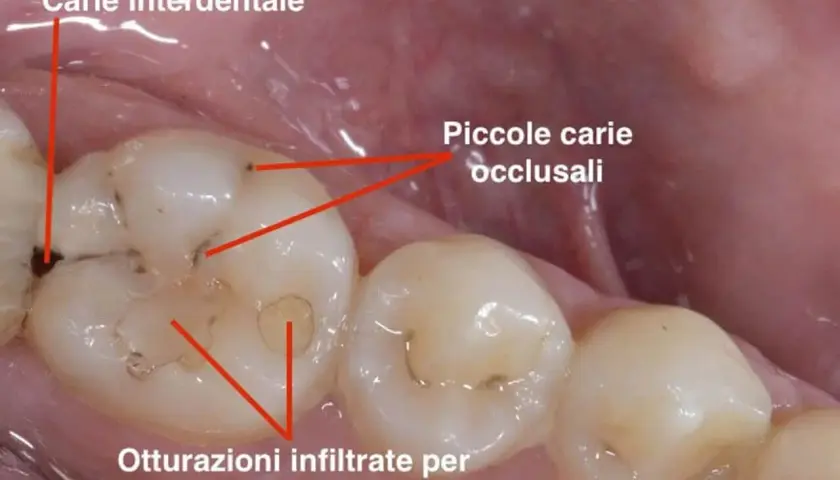 Denti con carie interdentale e occlusale, otturazioni infiltrate. Una situazione che può causare una sgradevole puzza tra i denti.
