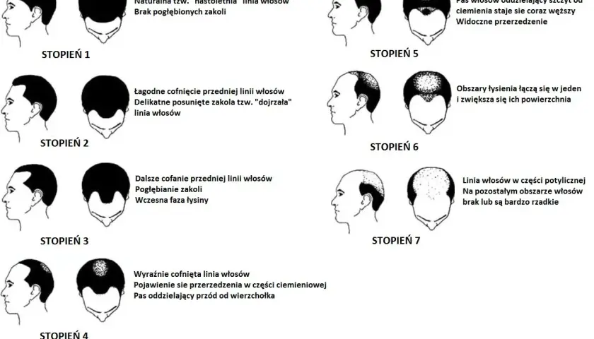 Ilustracja przedstawia 7 stopni łysienia u mężczyzn, od naturalnej linii włosów po całkowite wyłysienie.