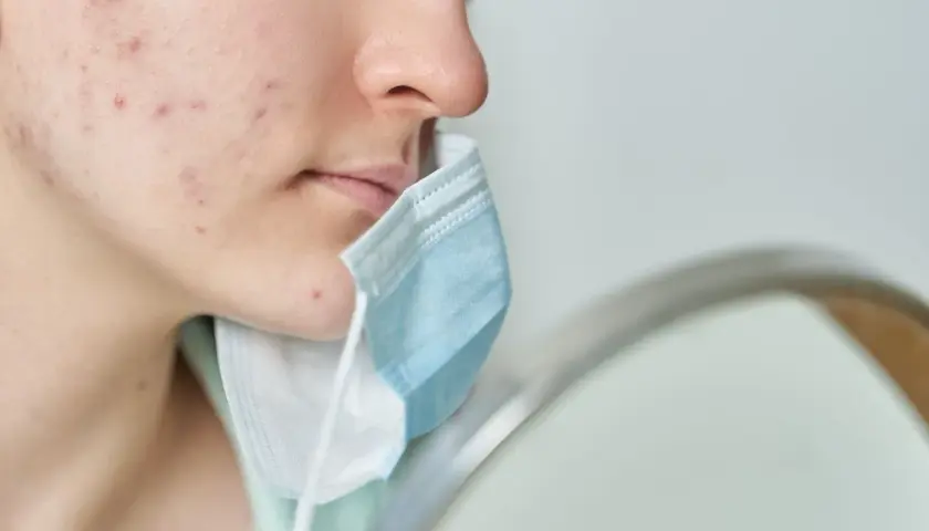 Primo piano di un viso con evidenti segni di acne da mascherina. La persona tiene una mascherina blu e bianca vicino al mento.