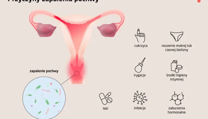 Ilustracja przedstawia przyczyny zapalenia pochwy: cukrzyca, mokra bielizna, irygacja, środki higieny intymnej, leki, infekcje, zaburzenia hormonalne.