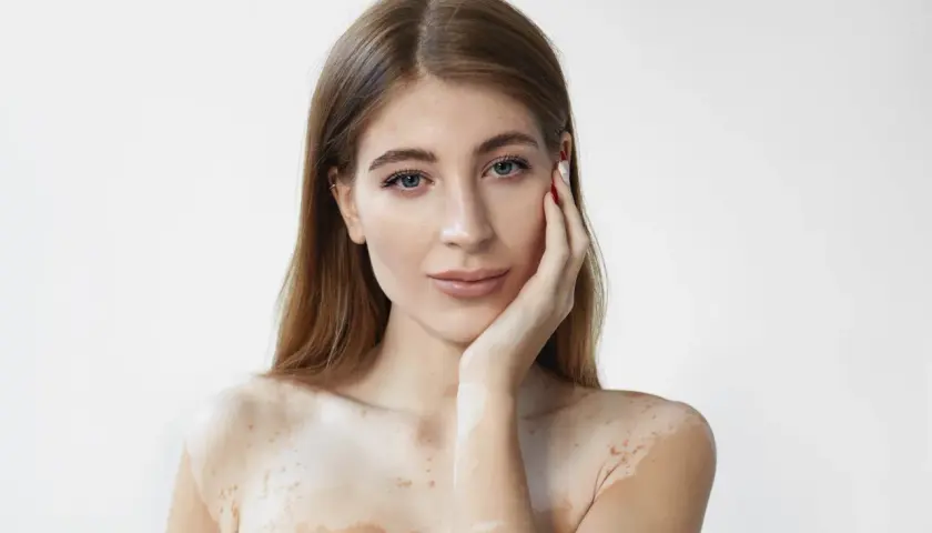 Mujer con vitiligo, su piel muestra áreas despigmentadas. El ácido salicílico para qué sirve: ayuda a exfoliar y mejorar la textura de la piel.