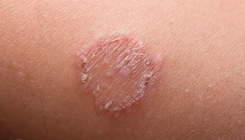 Macchie rosse sulla pelle, un'infezione fungina che forma un anello squamoso.