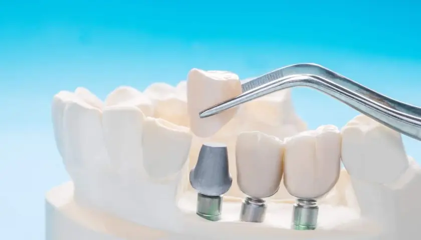 Un dente incapsulato viene posizionato con una pinzetta su un impianto dentale, parte di un modello di mascella.