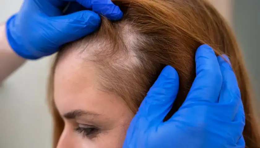 Manos enguantadas revisan el cuero cabelludo de una mujer, mostrando áreas de pérdida de cabello que podrían indicar un cuero cabelludo quemado.