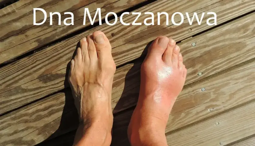 Dwa stopy na drewnianym tarasie. Jedna zdrowa, druga z obrzękiem i zaczerwienieniem, objawem dny moczanowej.