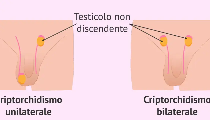Illustrazione medica che mostra il criptorchidismo, una condizione in cui un testicolo non è sceso. Il testicolo ritenuto bambino 10 anni può essere unilaterale o bilaterale.