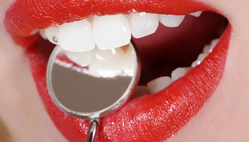 Labios rojos brillantes y dientes blancos examinados con un espejo dental. Averiguar cuanto se tarda en hacer un empaste pequeño es rápido.