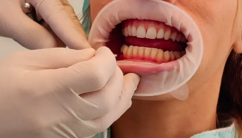 Mani guantate usano scovolini denti per pulire tra i denti di una persona con un divaricatore orale.