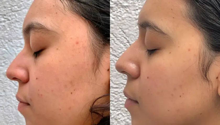 Comparativa de piel con acné y marcas. El lado "antes" muestra imperfecciones, mientras que el "después" revela una piel más lisa tras usar vitaminas para la cara.