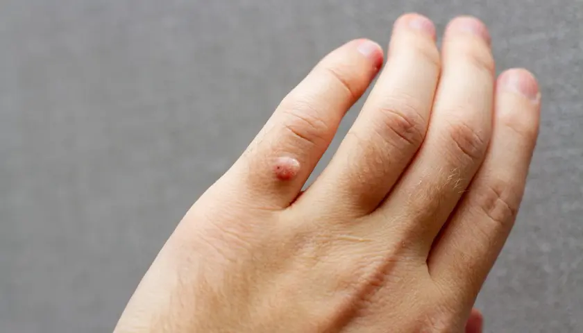 Närbild på en hand med en vårtliknande utväxt på ett finger. Det ser ut som att man vill dra ut vårta.