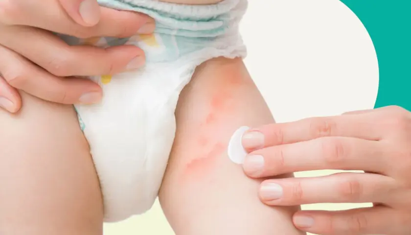 Mani applicano crema su un culetto neonato con rossore e piccoli puntini bianchi, per lenire la pelle irritata.