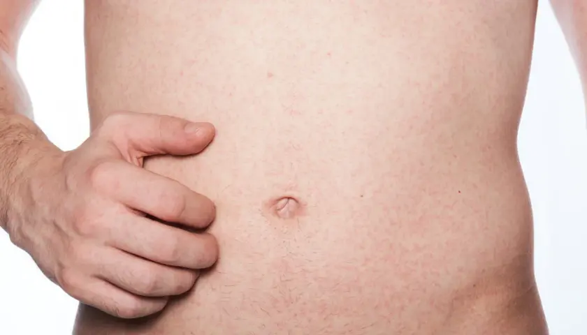 Ein Mann kratzt sich am Bauch, wo ein roter Ausschlag mit vielen kleinen Punkten zu sehen ist.