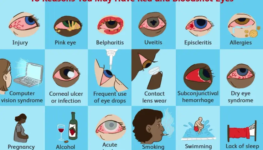 Varie cause di irritazione occhio: lesioni, infezioni, lenti a contatto, fumo, stanchezza e altro.
