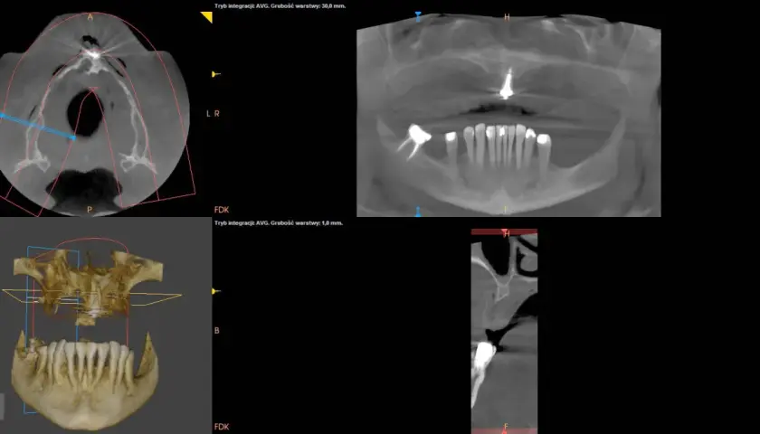 Badanie CBCT pokazuje przekroje zębów i szczęki. To nowoczesna metoda diagnostyki stomatologicznej.