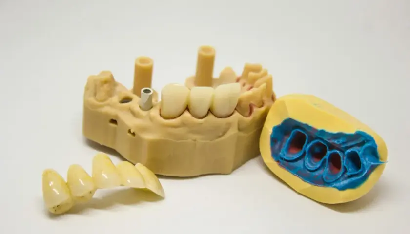 Model szczęki z implantami i mostkiem. Obok model wyciskowy szczęki. Proteza szkieletowa bezklamrowa w przygotowaniu.