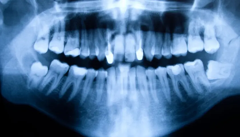 Radiografía panorámica dental que muestra una anomalía ósea, posiblemente un quiste en la boca, afectando la mandíbula inferior.