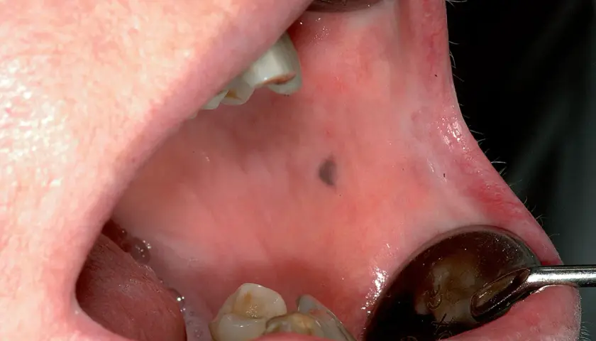 Una macchia scura sul palato, visibile vicino ai denti e a uno specchietto dentale.