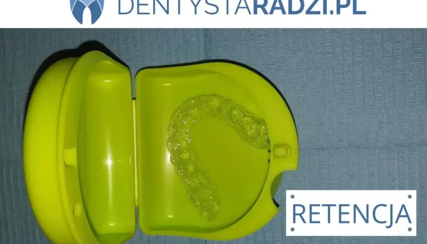 Cena nakładki retencyjnej po aparacie: Ile kosztuje i którą wybrać?