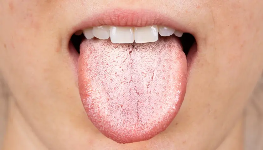 Lingua bianca e ruvida, possibile effetto collaterale di un antibiotico.