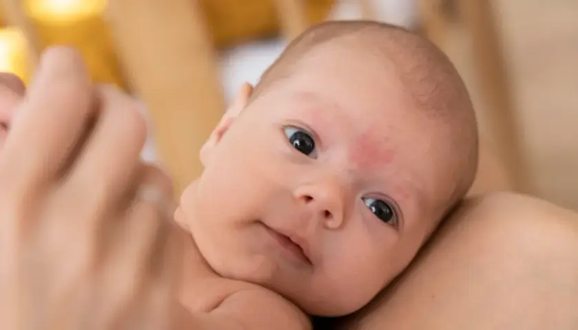 Primo piano di un neonato con pelle screpolata, tenuto in braccio.