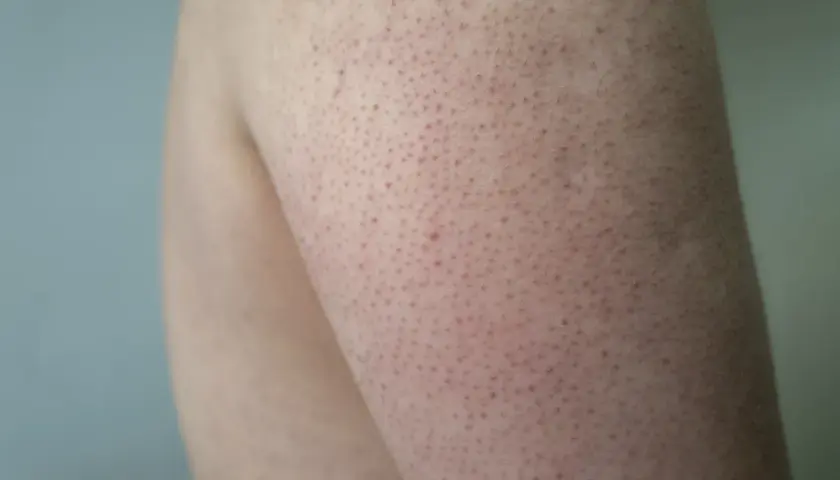 Närbild på en arm med keratosis pilaris hos ett barn. Små röda prickar syns över huden.