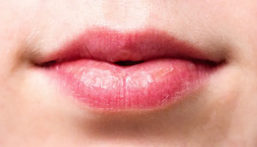 Labios agrietados y secos, con aspecto de labios quemados por el sol, muestran la necesidad de protección.