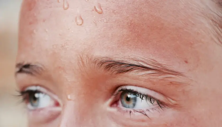 Gotas de sudor en la frente de una persona, un síntoma común de hiperhidrosis facial.