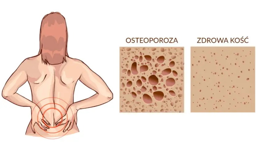 Ból pleców u kobiety z osteoporozą. Porównanie struktury kości: osteoporoza vs zdrowa kość. Czy osteoporoza to rak kości?
