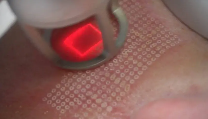 Zabieg laserem frakcyjnym: czy laser frakcyjny jest bezpieczny? Skóra po zabiegu z widocznymi mikrouszkodzeniami.