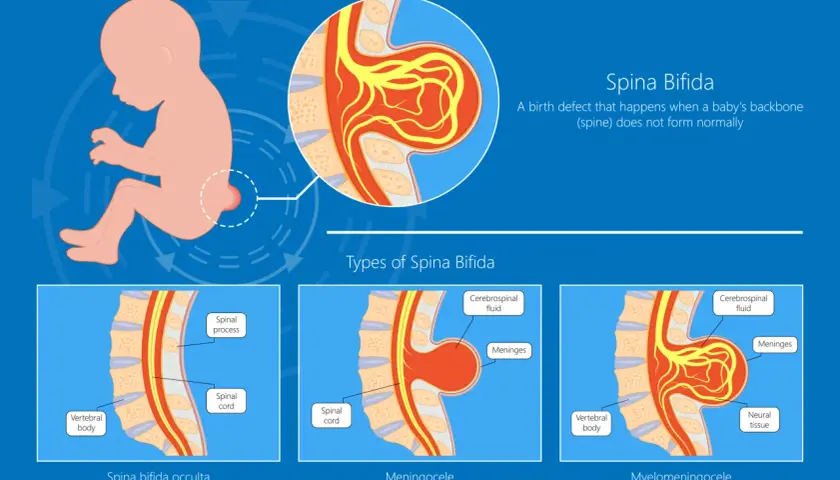 Ilustracja pokazuje wady kręgosłupa u niemowlaka: spina bifida occulta, meningocele i myelomeningocele, gdzie wystający kręgosłup jest widoczny.