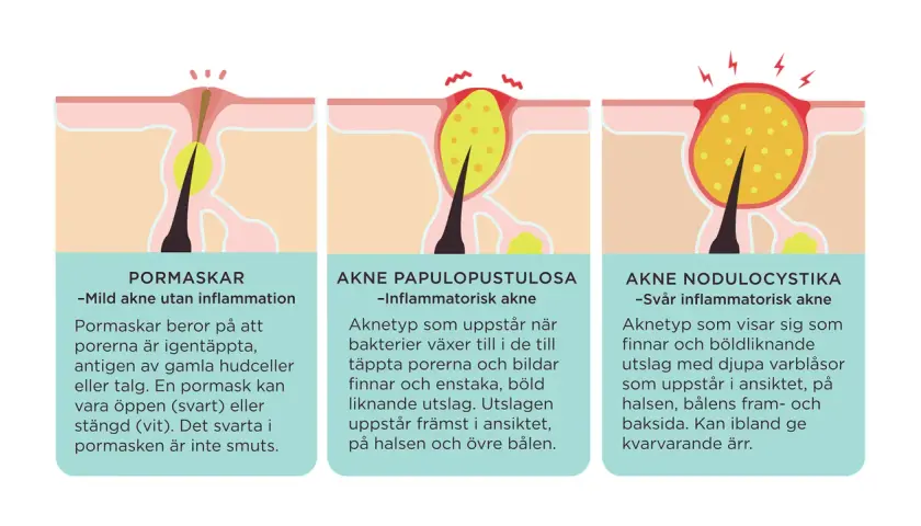 Illustrationer visar olika typer av hormonella utslag: pormaskar, inflammatorisk akne och svår akne med djupa varblåsor.