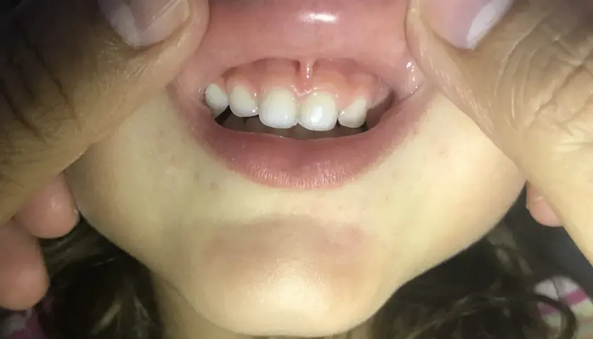 Boca de niño con dientes frontales y el frenillo del labio inferior visible.