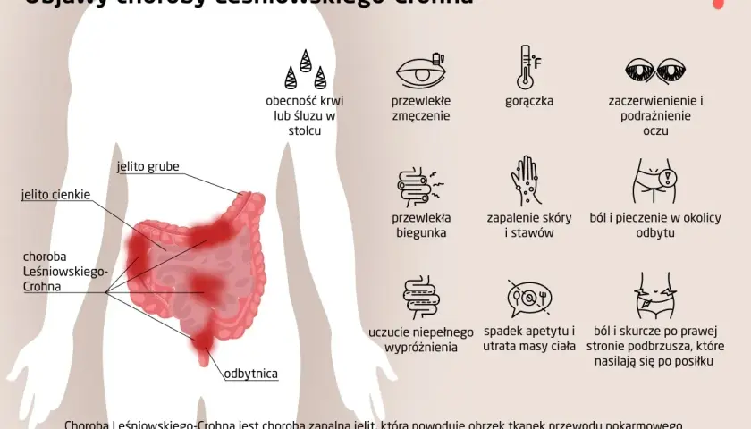 Ilustracja przedstawia objawy choroby Leśniowskiego-Crohna: zmęczenie, gorączkę, biegunkę, ból brzucha, problemy z oczami i skórą.