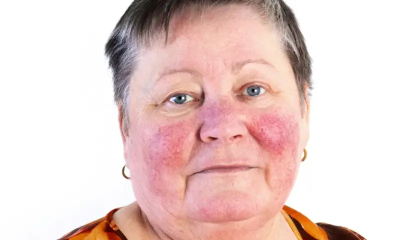 Kvinna med rodnad i ansiktet, troligen rosacea. Hennes hals är också påverkad.