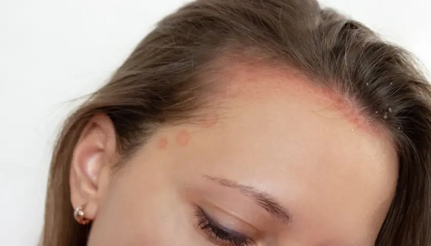 Marcas rojizas y escamas en la frente y cuero cabelludo, indicativo de dermatitis seborreica.