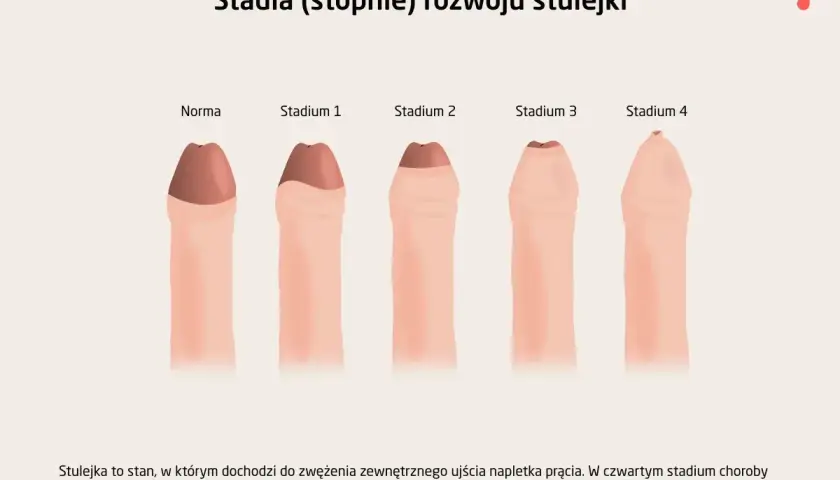 Ilustracja przedstawia stadia rozwoju stulejki u dorosłego, od normy do stadium 4, ukazując zwężenie napletka.