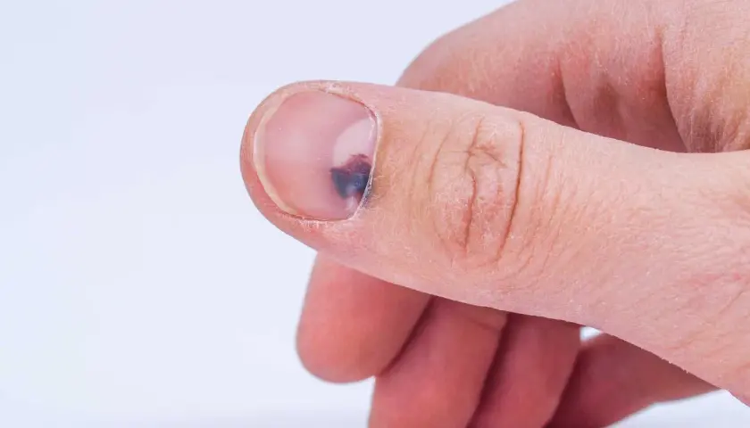 Ein blauer Fleck unter dem Fingernagel, vielleicht durch einen Stoß. Hausmittel können bei solchen Blutergüssen helfen.
