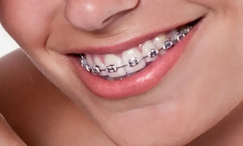 Jak wygląda zakładanie aparatu na zęby – co musisz wiedzieć przed wizytą