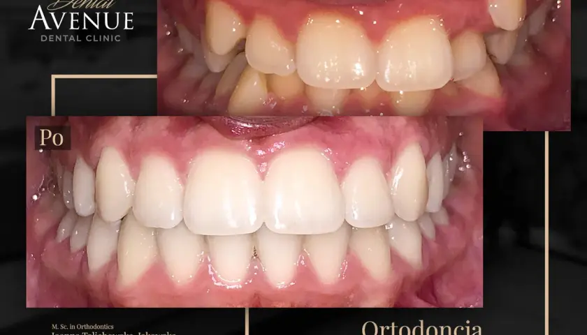 Aparat ortodontyczny przed i po: krzywe zęby wyprostowane, piękny uśmiech. Ortodoncja w Dental Avenue.