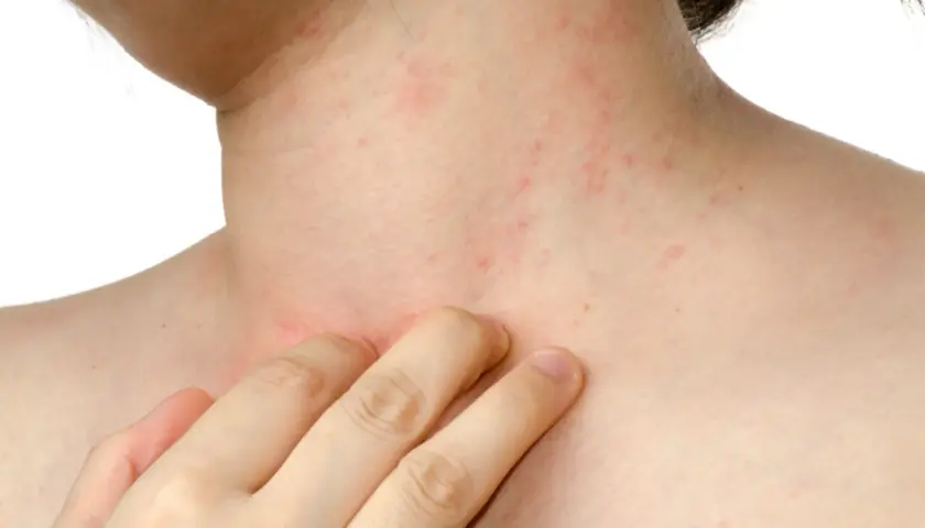Pelle arrossata e irritata sul collo e sul petto, con piccole macchie rosse, sintomo di dermatite da stress.