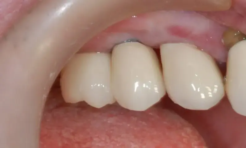 Skutki uboczne implantów z tytanu: jakie powikłania mogą cię zaskoczyć?